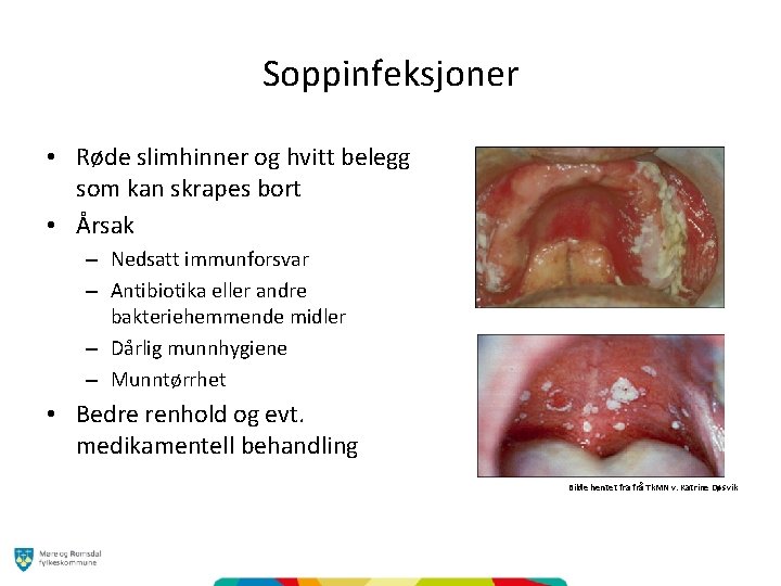 Soppinfeksjoner • Røde slimhinner og hvitt belegg som kan skrapes bort • Årsak –