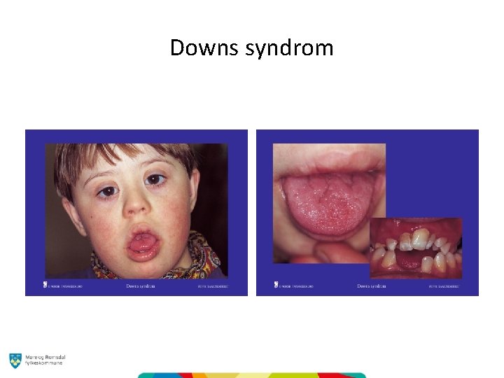 Downs syndrom 