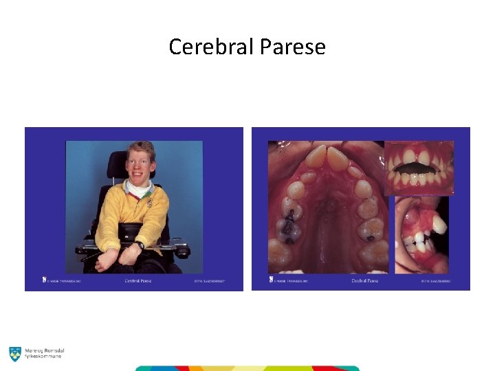 Cerebral Parese 