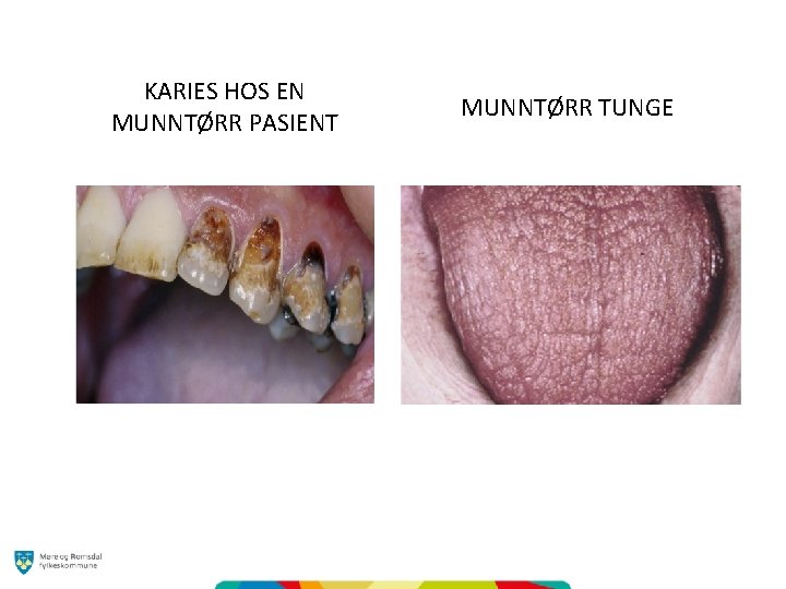 KARIES HOS EN MUNNTØRR PASIENT MUNNTØRR TUNGE 