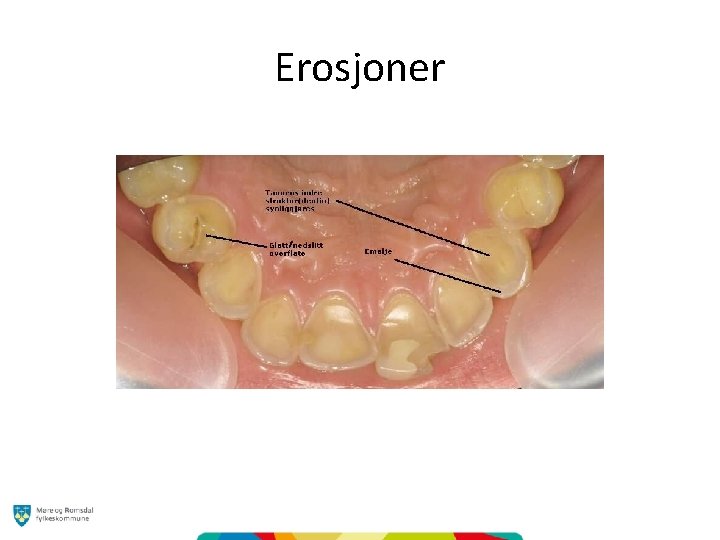 Erosjoner 