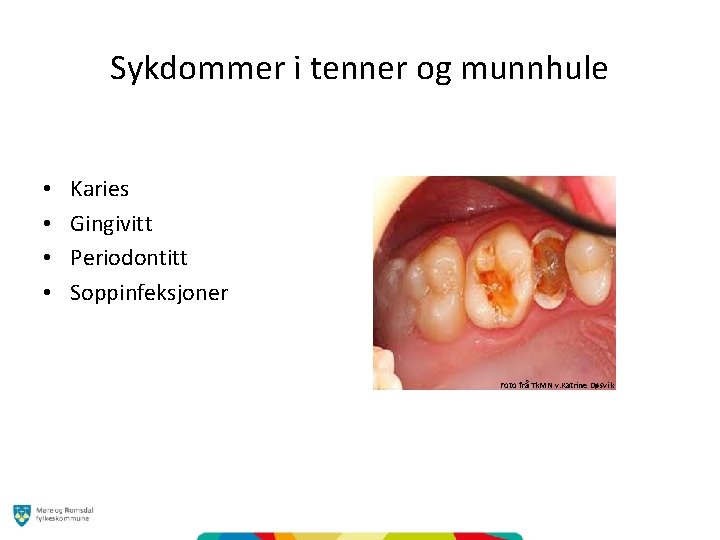 Sykdommer i tenner og munnhule • • Karies Gingivitt Periodontitt Soppinfeksjoner Foto frå Tk.