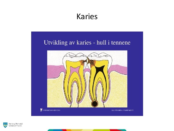 Karies 