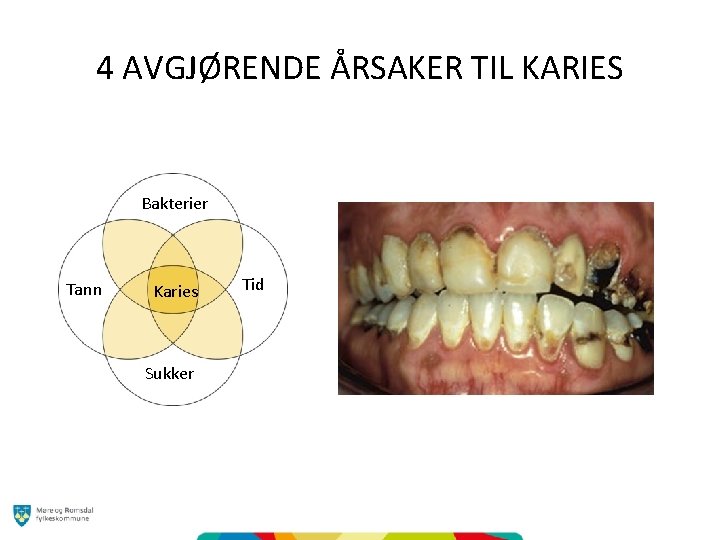 4 AVGJØRENDE ÅRSAKER TIL KARIES Bakterier Tann Karies Sukker Tid 