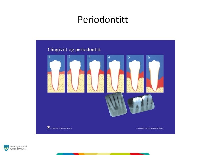 Periodontitt 