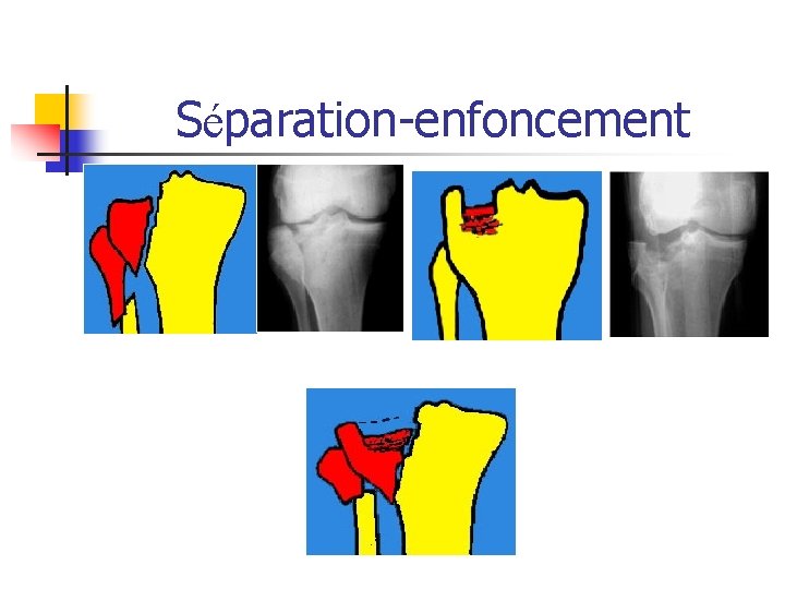 Séparation-enfoncement Séparation-enfoncement