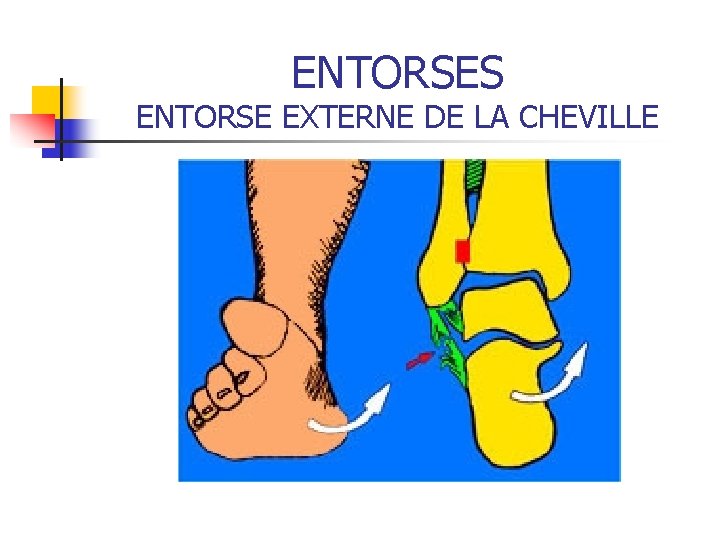 ENTORSES ENTORSE EXTERNE DE LA CHEVILLE ENTORSES ENTORSE EXTERNE DE LA CHEVILLE