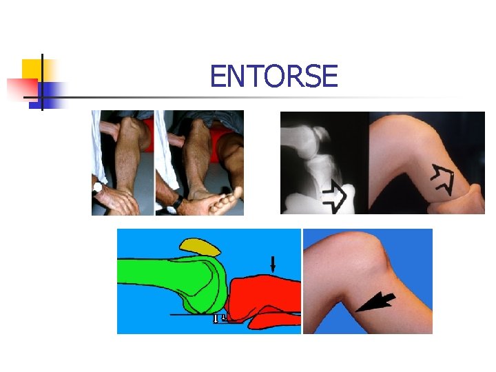 ENTORSE ENTORSE