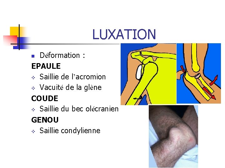 LUXATION Déformation : EPAULE v Saillie de l’acromion v Vacuité de la glène COUDE LUXATION Déformation : EPAULE v Saillie de l’acromion v Vacuité de la glène COUDE