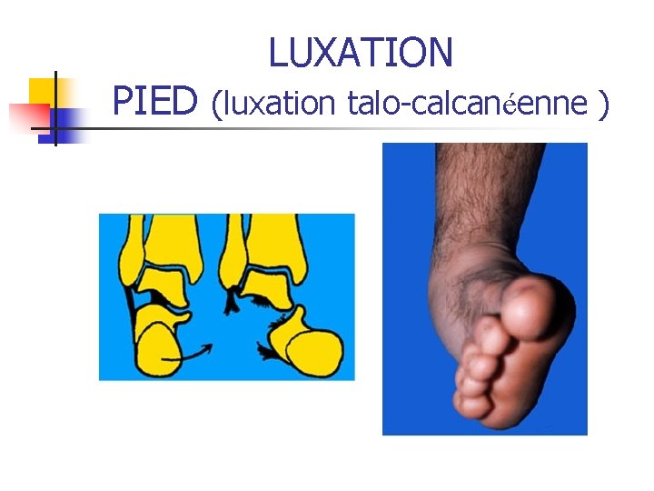 LUXATION PIED (luxation talo-calcanéenne ) LUXATION PIED (luxation talo-calcanéenne )