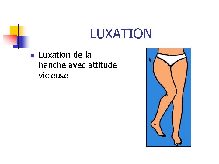 LUXATION n Luxation de la hanche avec attitude vicieuse LUXATION n Luxation de la hanche avec attitude vicieuse
