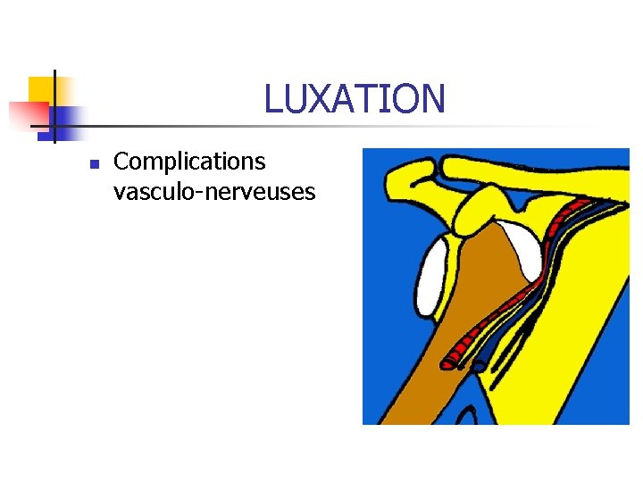 LUXATION n Complications vasculo-nerveuses LUXATION n Complications vasculo-nerveuses
