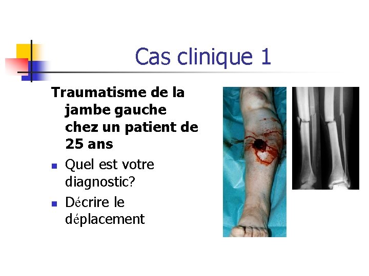 Cas clinique 1 Traumatisme de la jambe gauche chez un patient de 25 ans Cas clinique 1 Traumatisme de la jambe gauche chez un patient de 25 ans