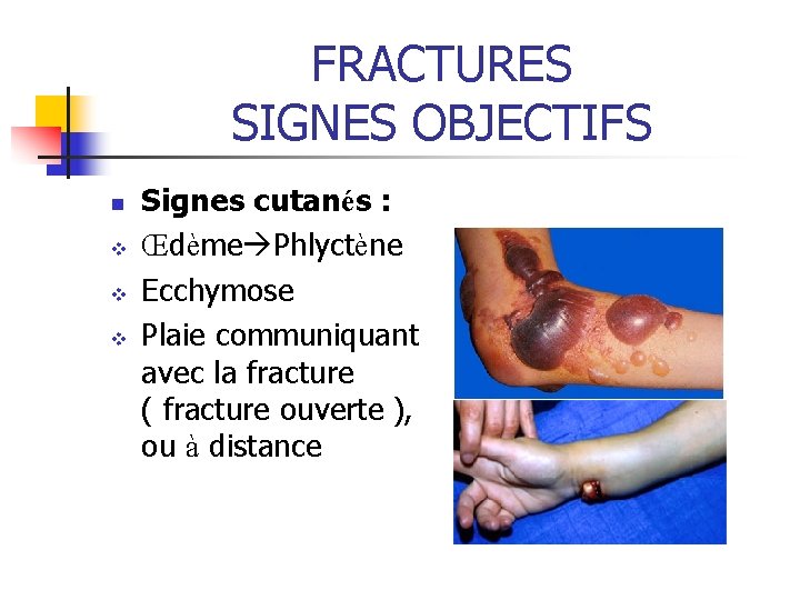 FRACTURES SIGNES OBJECTIFS n v v v Signes cutanés : Œdème Phlyctène Ecchymose Plaie FRACTURES SIGNES OBJECTIFS n v v v Signes cutanés : Œdème Phlyctène Ecchymose Plaie