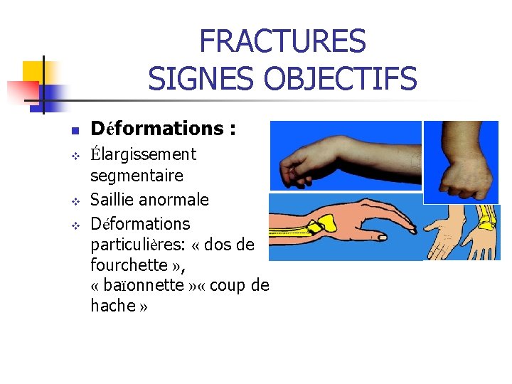 FRACTURES SIGNES OBJECTIFS n v v v Déformations : Élargissement segmentaire Saillie anormale Déformations FRACTURES SIGNES OBJECTIFS n v v v Déformations : Élargissement segmentaire Saillie anormale Déformations