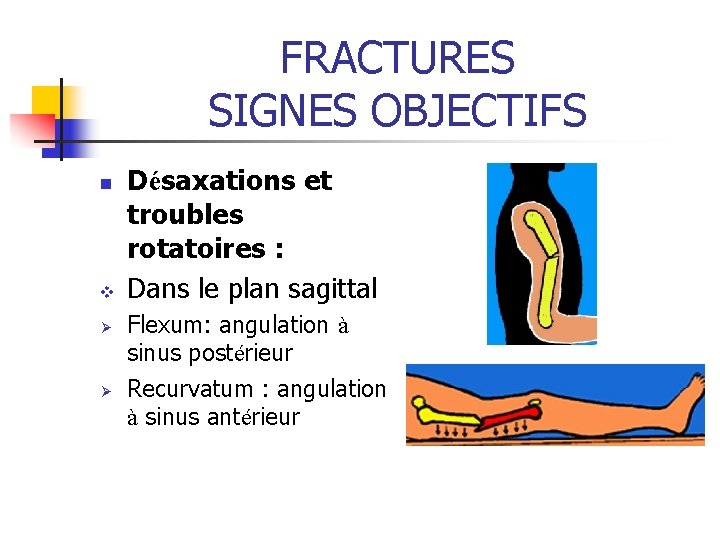 FRACTURES SIGNES OBJECTIFS n v Ø Ø Désaxations et troubles rotatoires : Dans le FRACTURES SIGNES OBJECTIFS n v Ø Ø Désaxations et troubles rotatoires : Dans le