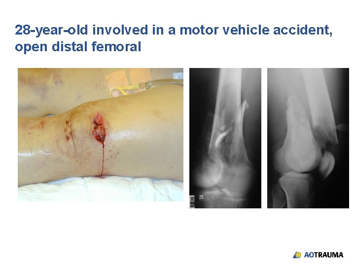 28 -year-old involved in a motor vehicle accident, open distal femoral 28 -year-old involved in a motor vehicle accident, open distal femoral
