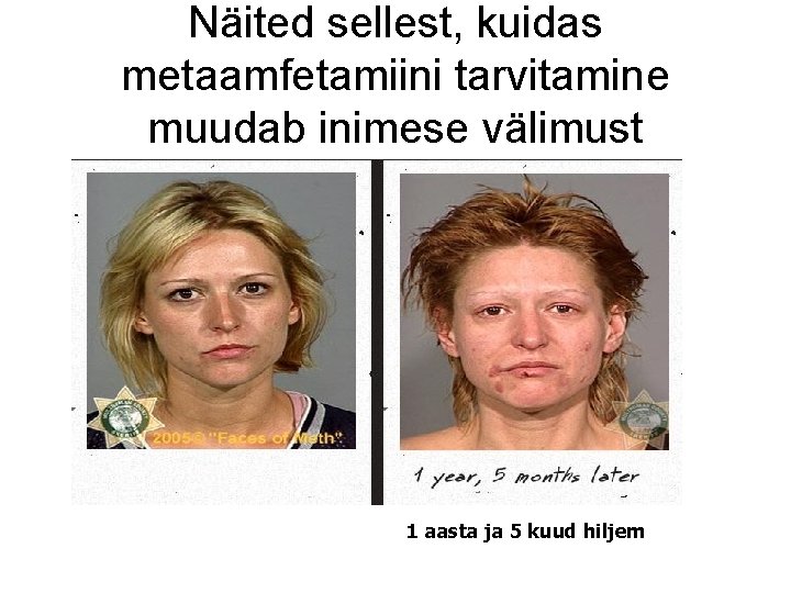 Näited sellest, kuidas metaamfetamiini tarvitamine muudab inimese välimust 1 aasta ja 5 kuud hiljem Näited sellest, kuidas metaamfetamiini tarvitamine muudab inimese välimust 1 aasta ja 5 kuud hiljem