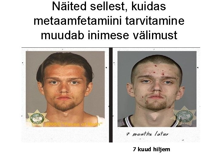 Näited sellest, kuidas metaamfetamiini tarvitamine muudab inimese välimust 7 kuud hiljem Näited sellest, kuidas metaamfetamiini tarvitamine muudab inimese välimust 7 kuud hiljem