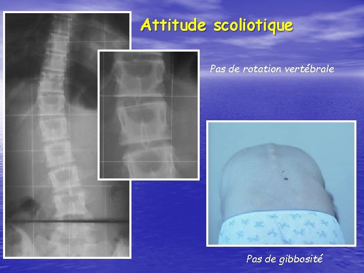 Attitude scoliotique Pas de rotation vertébrale Pas de gibbosité 