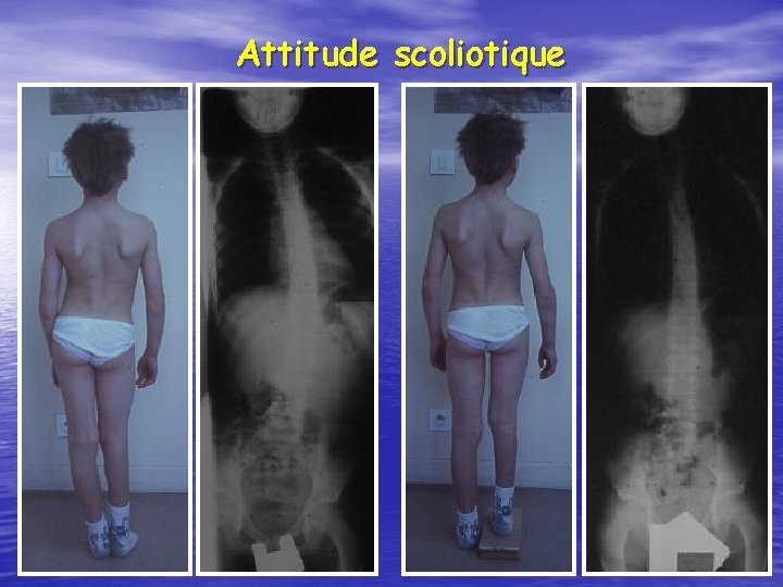 Attitude scoliotique 