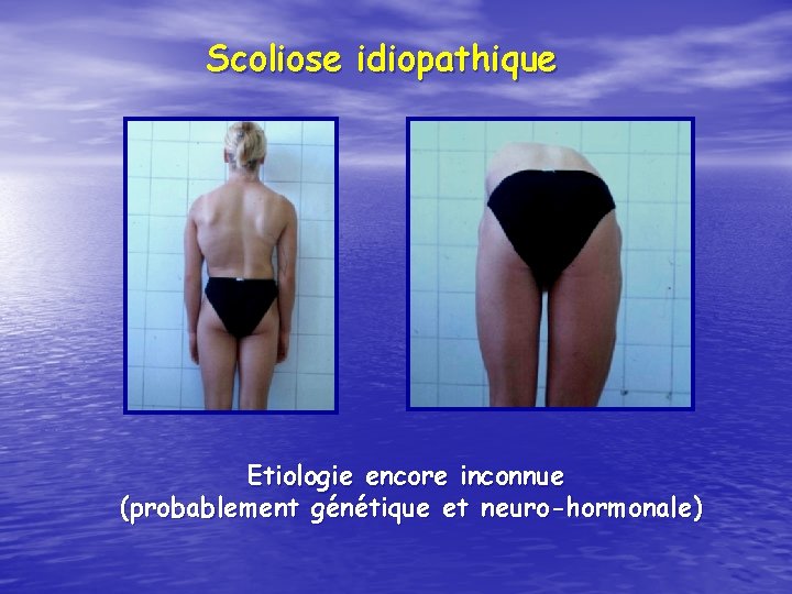 Scoliose idiopathique Etiologie encore inconnue (probablement génétique et neuro-hormonale) 
