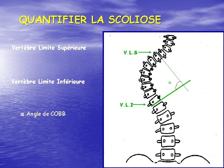 QUANTIFIER LA SCOLIOSE Vertèbre Limite Supérieure V. L. S Vertèbre Limite Inférieure V. L.