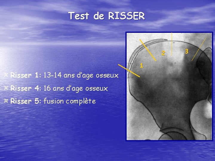 Test de RISSER 2 1 ¤ Risser 1: 13 -14 ans d’age osseux ¤