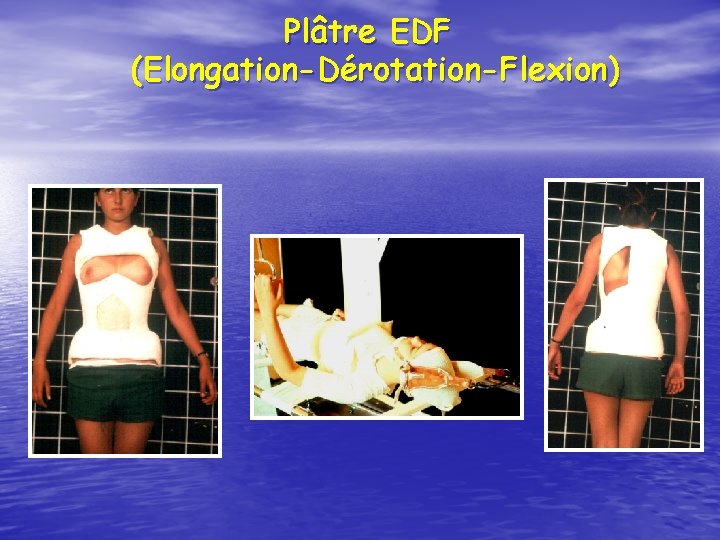 Plâtre EDF (Elongation-Dérotation-Flexion) 