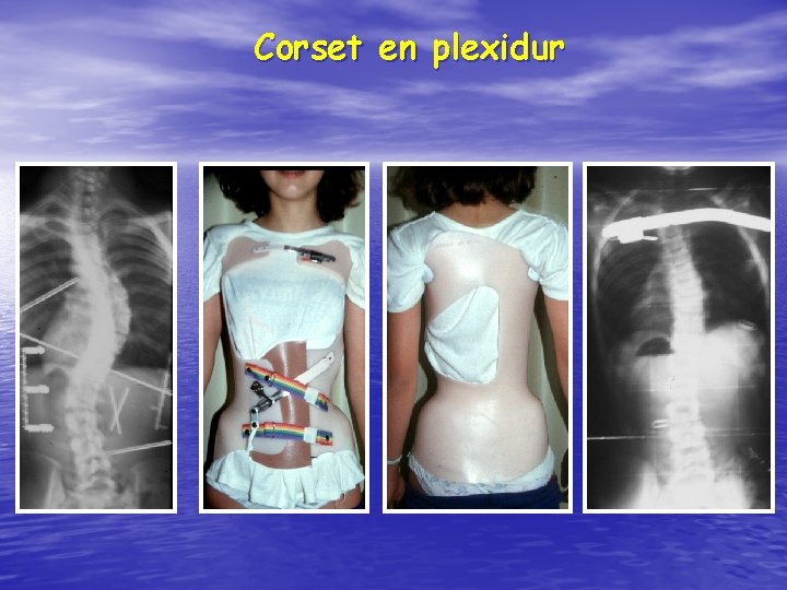 Corset en plexidur 