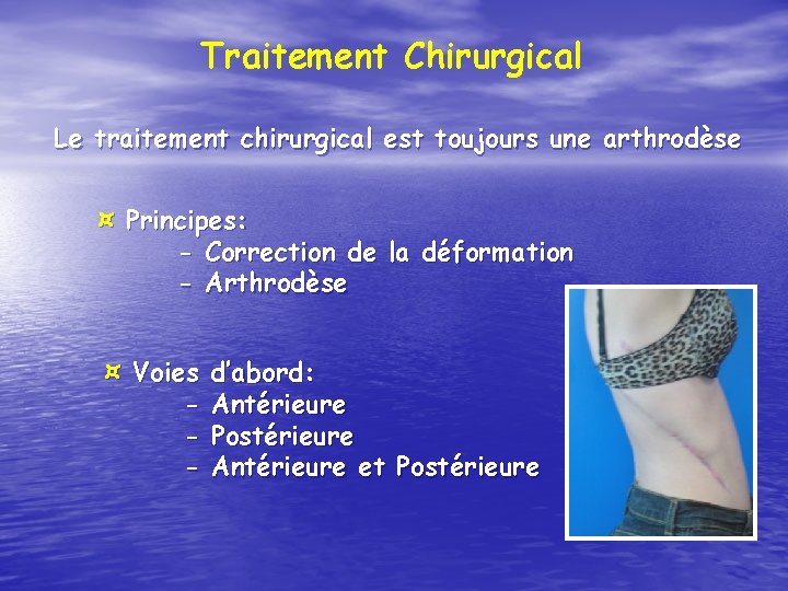 Traitement Chirurgical Le traitement chirurgical est toujours une arthrodèse ¤ Principes: - Correction de