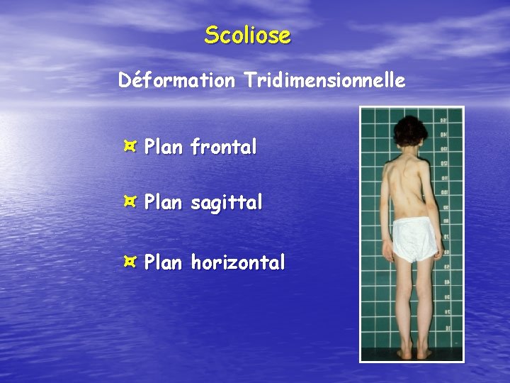 Scoliose Déformation Tridimensionnelle ¤ Plan frontal ¤ Plan sagittal ¤ Plan horizontal 