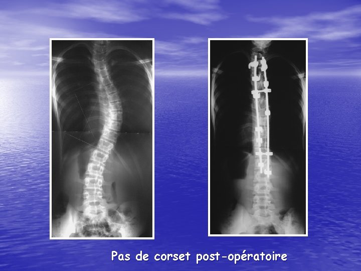 Pas de corset post-opératoire 