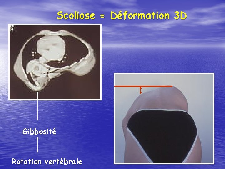 Scoliose = Déformation 3 D Gibbosité Rotation vertébrale 