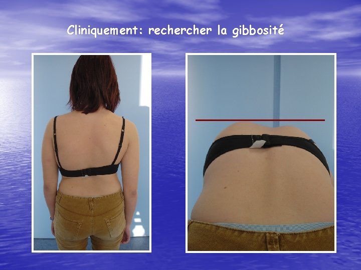 Cliniquement: recher la gibbosité 