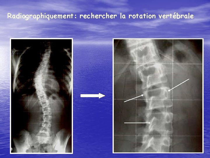 Radiographiquement: recher la rotation vertébrale 