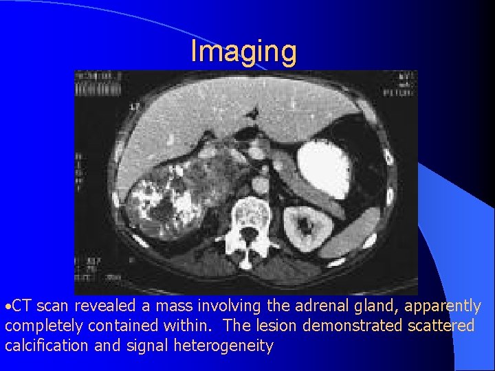 Imaging • CT scan revealed a mass involving the adrenal gland, apparently completely contained