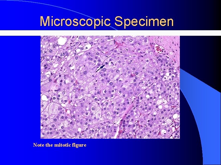 Microscopic Specimen Note the mitotic figure 