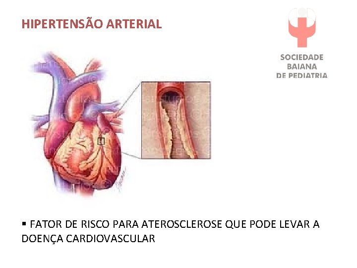 HIPERTENSÃO ARTERIAL § FATOR DE RISCO PARA ATEROSCLEROSE QUE PODE LEVAR A DOENÇA CARDIOVASCULAR