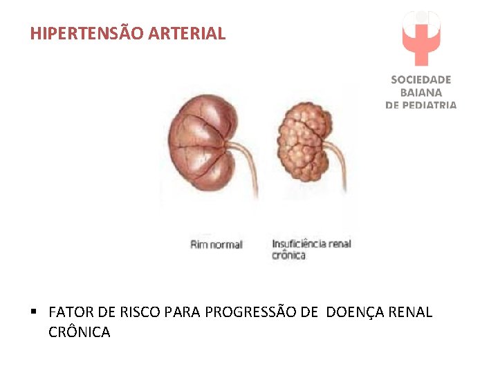 HIPERTENSÃO ARTERIAL § FATOR DE RISCO PARA PROGRESSÃO DE DOENÇA RENAL CRÔNICA 