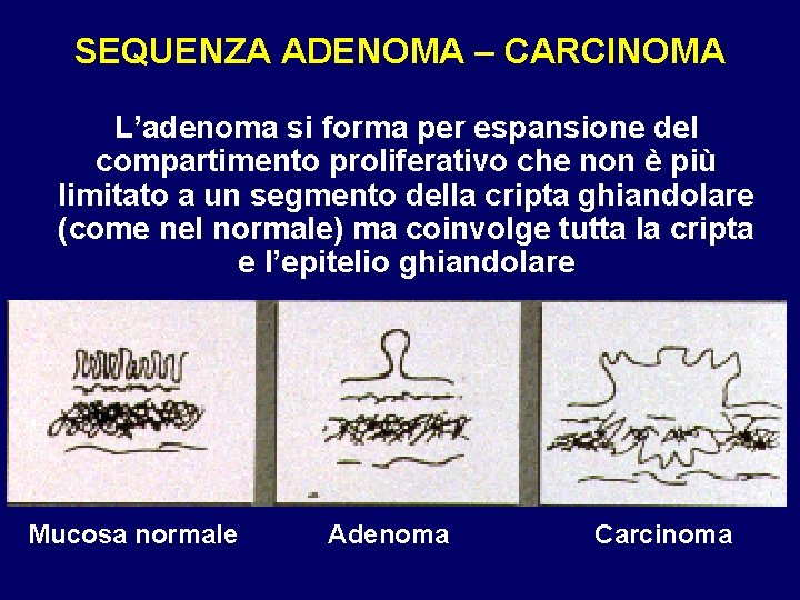 SEQUENZA ADENOMA – CARCINOMA L’adenoma si forma per espansione del compartimento proliferativo che non SEQUENZA ADENOMA – CARCINOMA L’adenoma si forma per espansione del compartimento proliferativo che non