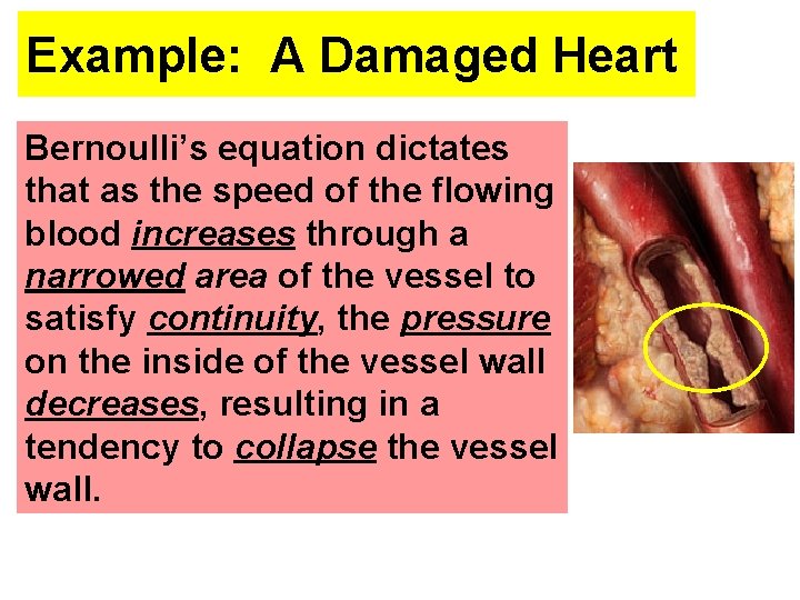 Example: A Damaged Heart Bernoulli’s equation dictates that as the speed of the flowing