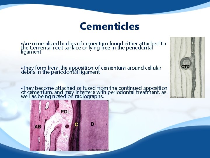 Cementicles §Are mineralized bodies of cementum found either attached to the Cemental root surface