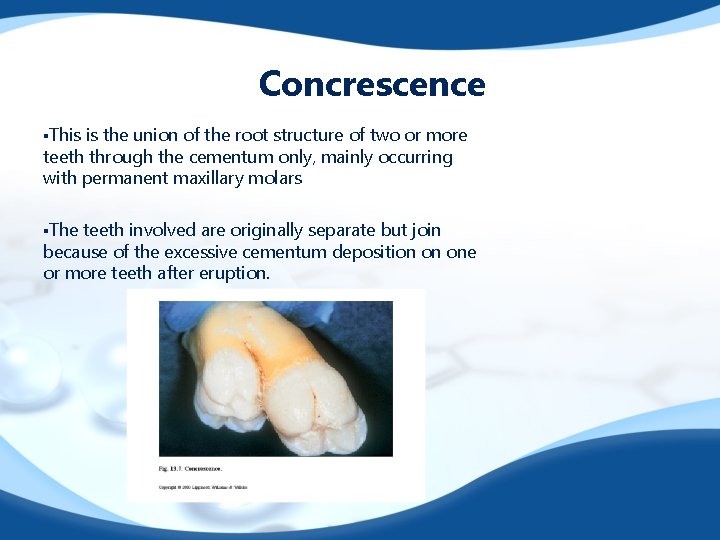 Concrescence §This is the union of the root structure of two or more teeth