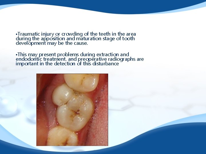 §Traumatic injury or crowding of the teeth in the area during the apposition and