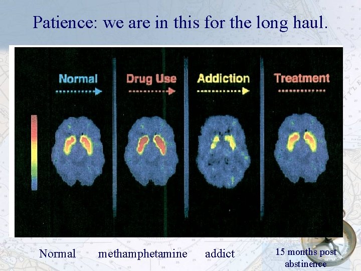 Patience: we are in this for the long haul. Normal methamphetamine addict 15 months