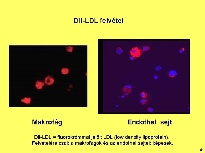 Dil-LDL felvétel Makrofág Endothel sejt Di. I-LDL = fluorokrómmal jelölt LDL (low density lipoprotein).