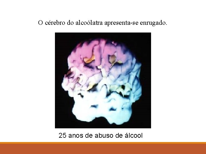 O cérebro do alcoólatra apresenta-se enrugado. 25 anos de abuso de álcool 