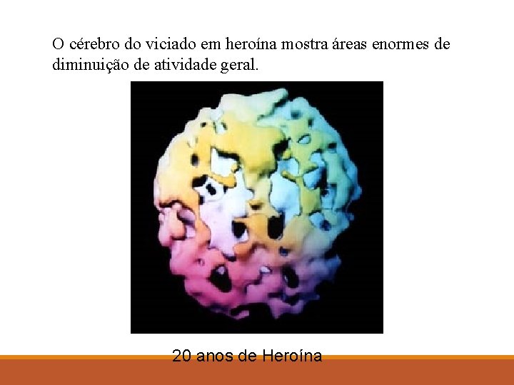 O cérebro do viciado em heroína mostra áreas enormes de diminuição de atividade geral.