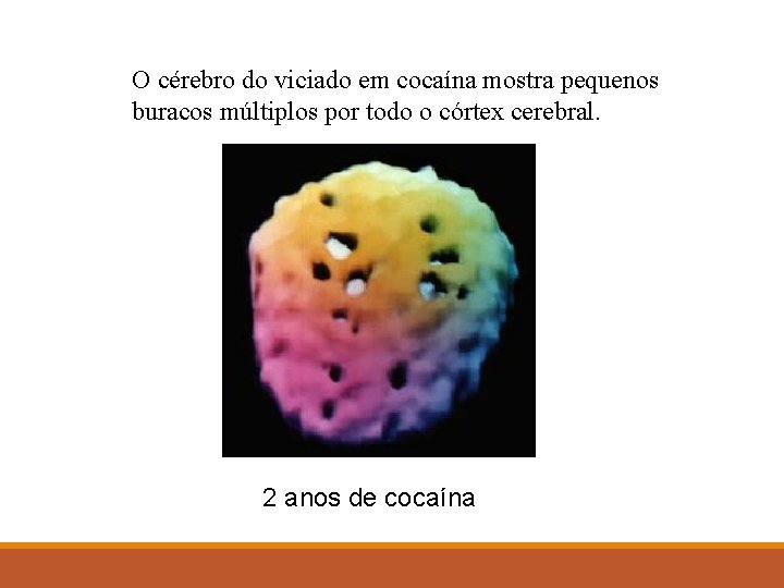 O cérebro do viciado em cocaína mostra pequenos buracos múltiplos por todo o córtex